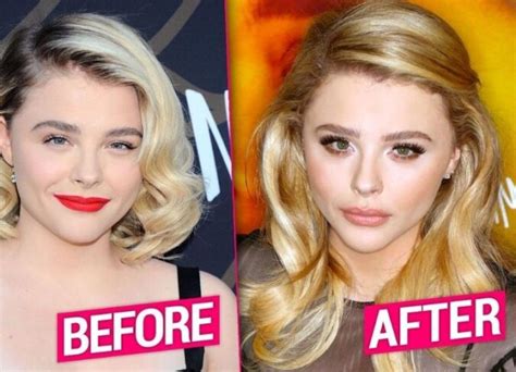 chloe grace moretz surgery|chloe moretz before and after.